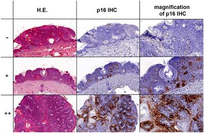 Detection of Merkel Cell Polyomavirus in Seborrheic Keratosis